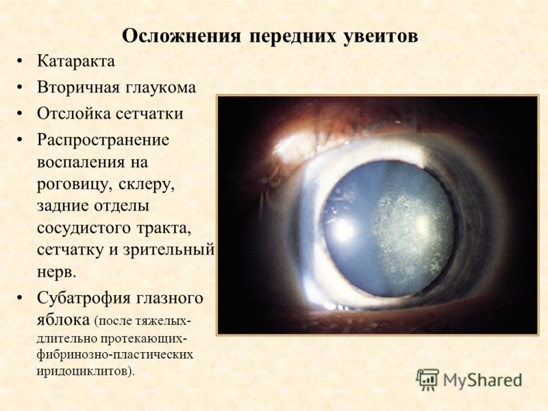 Вторичная катаракта после операции. Отслойка сетчатки катаракта. Увеит, Ирит, иридоциклит.
